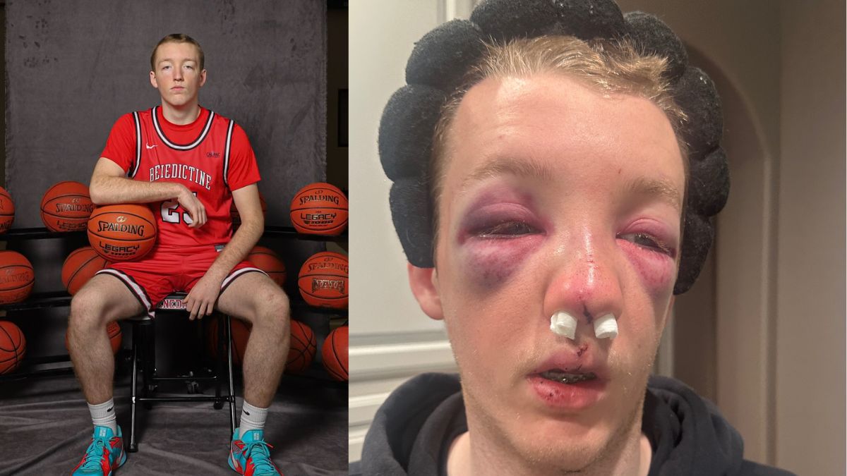Chandler Native Dylan Alvidrez Suffers Severe Facial Trauma in Court Accident