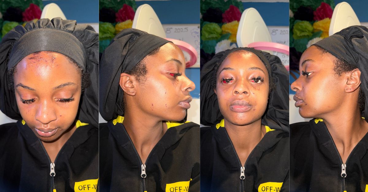 UDC Athlete Battles After Brutal Assault Leaves Her Shaken But Unbroken